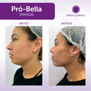 Pró-Bella Papada Antes e Depois