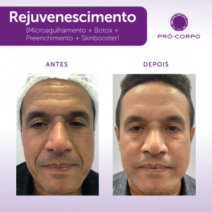 Bigode Chinês - Fotos Antes e Depois