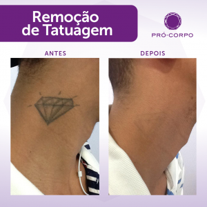 Remoção de Tatuagem: Fotos de Antes e Depois