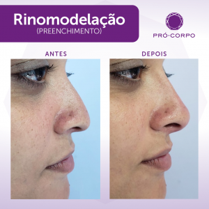 Rinomodelação Pró-Corpo Estética Avançada