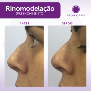 Rinomodelação Pró-Corpo Estética Avançada