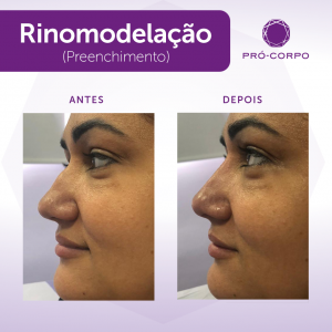 Rinomodelação Pró-Corpo Estética Avançada