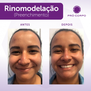 Rinomodelação Pró-Corpo Estética Avançada