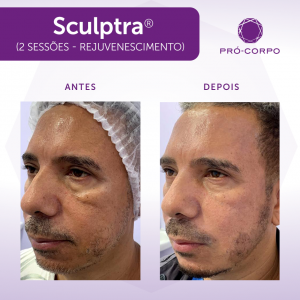 Sculptra Antes e Depois