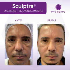 Sculptra Antes e Depois