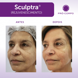 Rejuvenescimento: Fotos de Antes e Depois