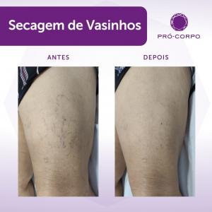 Secagem de Vasinhos Antes e Depois