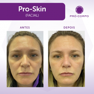 Pró-Skin Antes e Depois