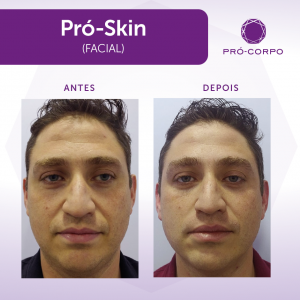 Pró-Skin Antes e Depois