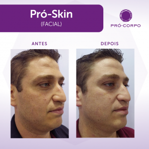 Pró-Skin Antes e Depois