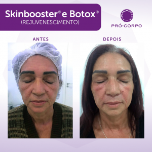 Skinbooster Antes e Depois