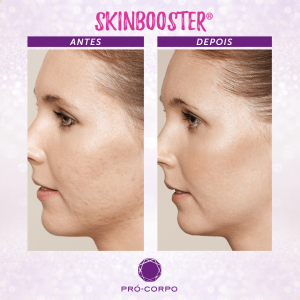 Skinbooster Antes e Depois